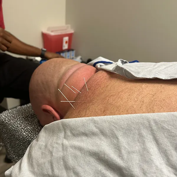 Harrisburg, NC Chiropractor - Dry Needling